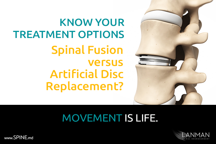 artificial disc replacement