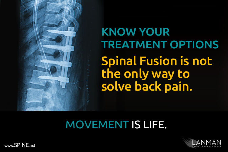 Artificial Disc Replacement As An Alternative For Failed Spinal Fusion |  Spine.md