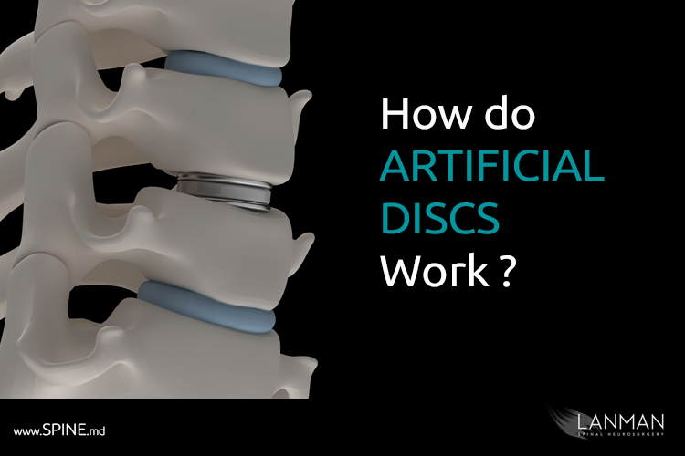 Artificial Disc Replacement (ADR) how do they work. Spine.MD
