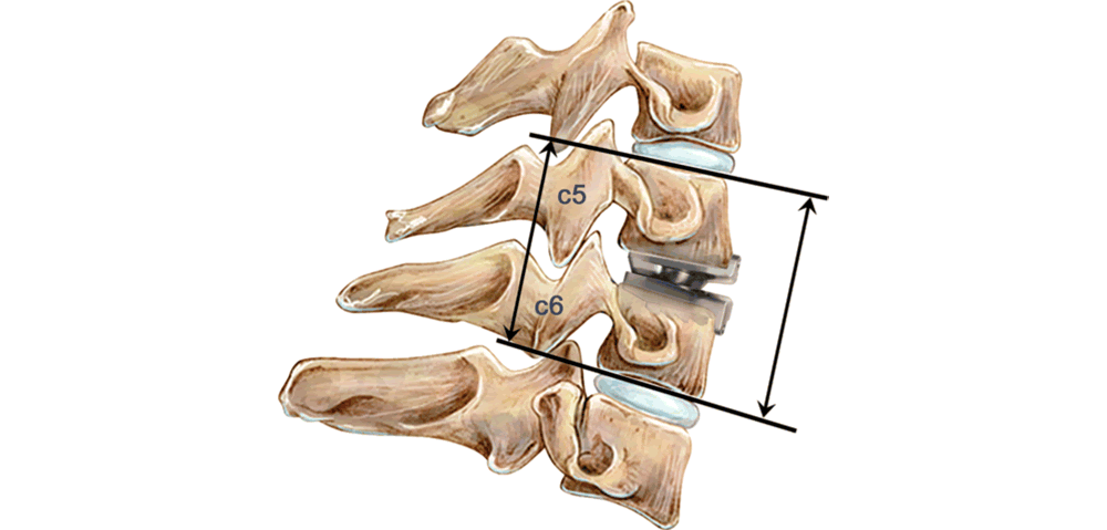 Artificial Disc Replacement vs Spinal Fusion Spine.MD