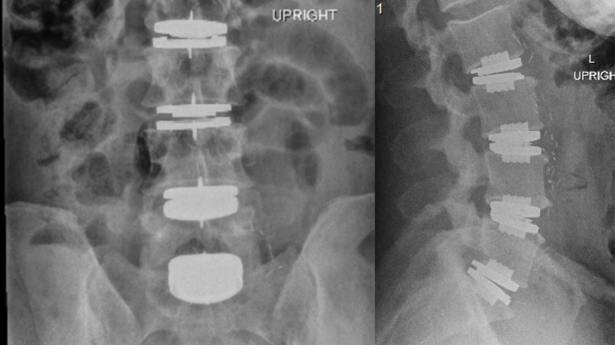 20 Years of Back Pain